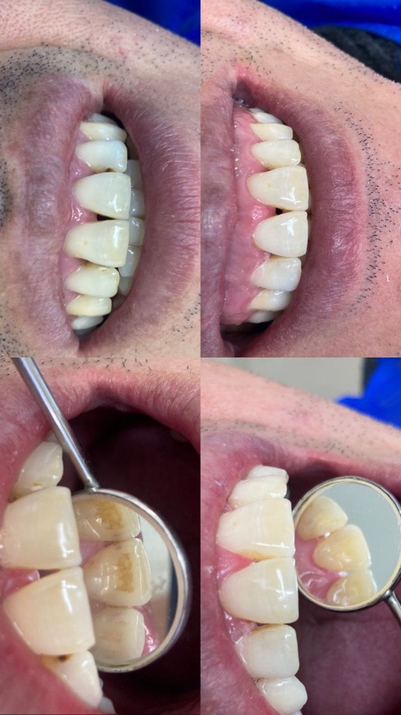 Antes y después - Caso clínico dental