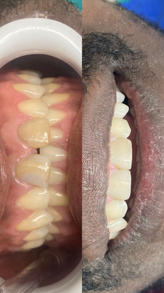 Antes y después