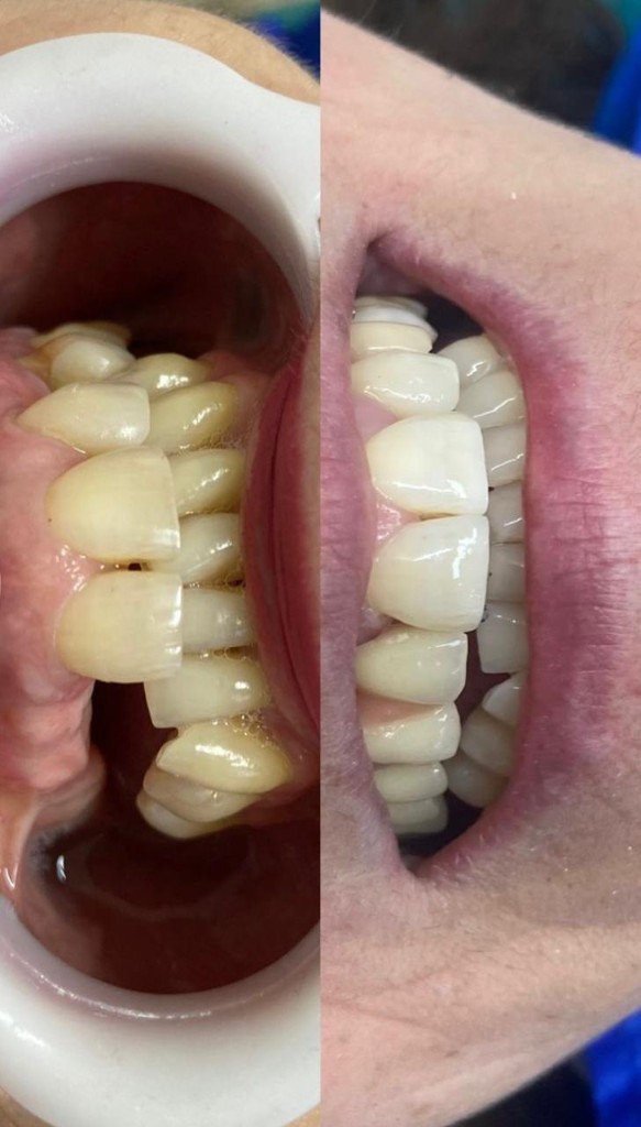 Antes y después