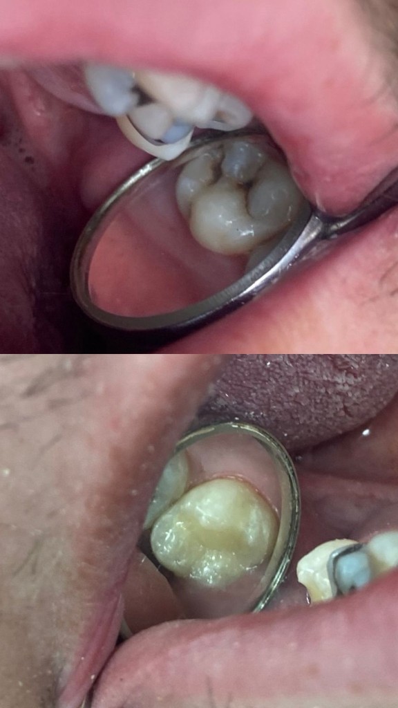 Antes y después