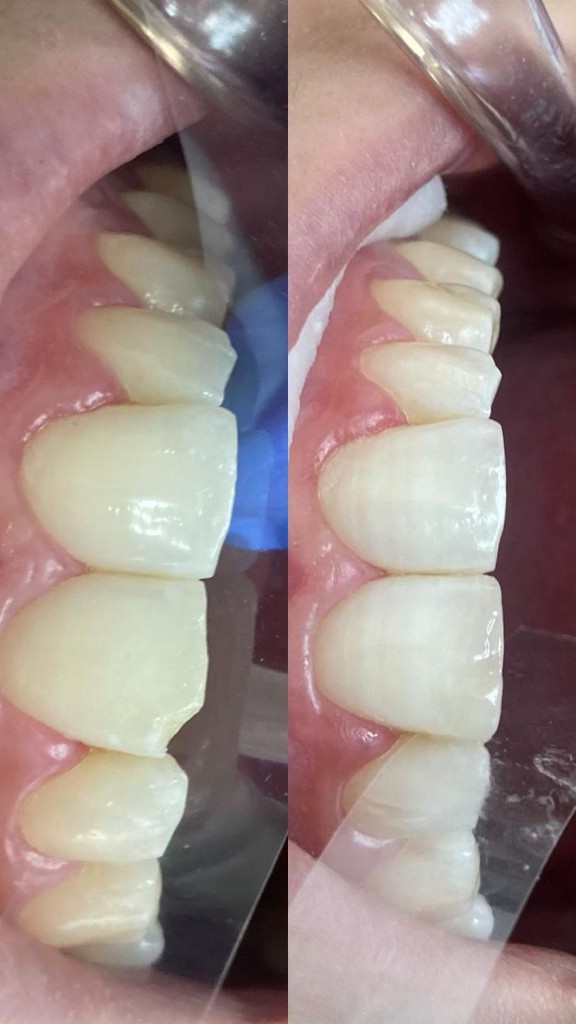 Antes y después